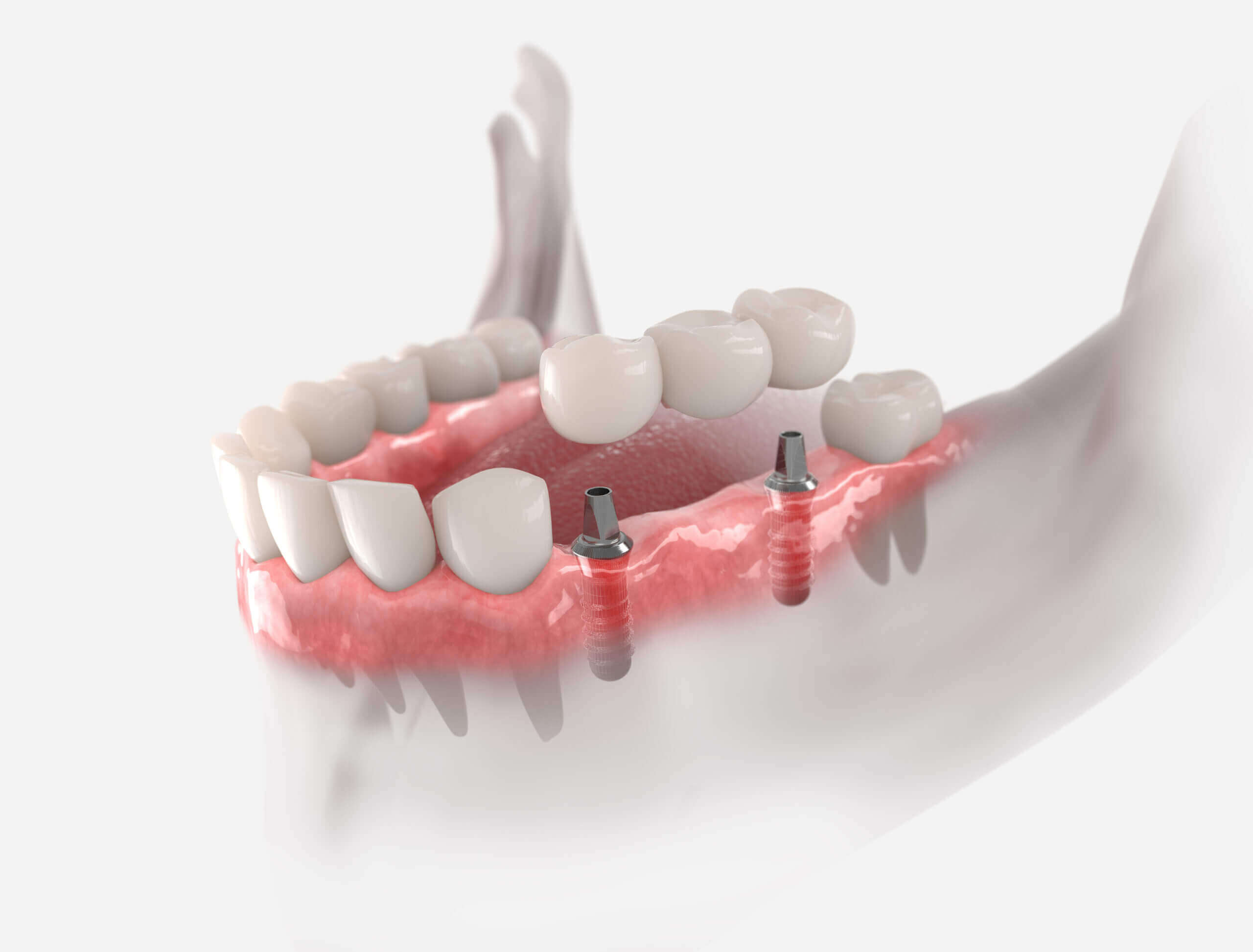 Restore your smile with custom dental bridges from My Smile Dental in San Antonio, offering traditional, cantilever, Maryland, and implant-supported options to replace missing teeth and enhance oral function.