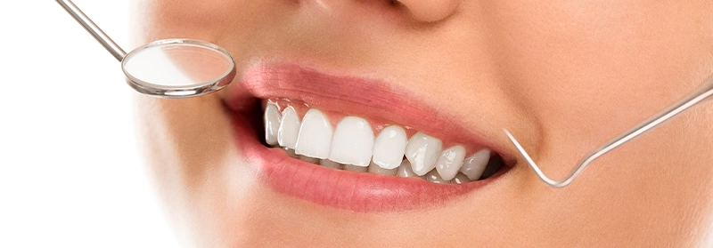 Enhanced smile with perfectly aligned, white teeth after cosmetic dentistry