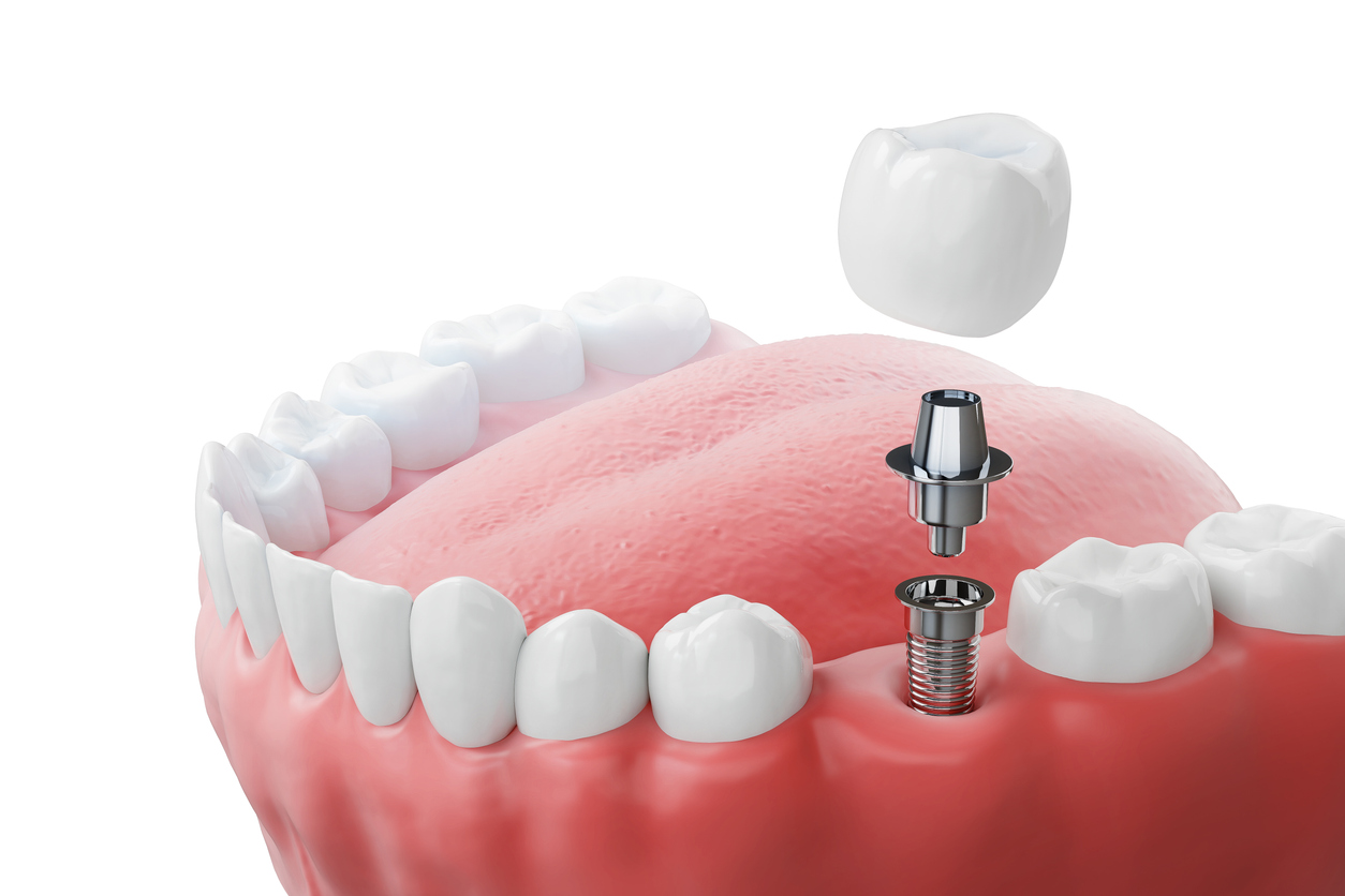 Dentist examining a dental implant during a follow-up appointment