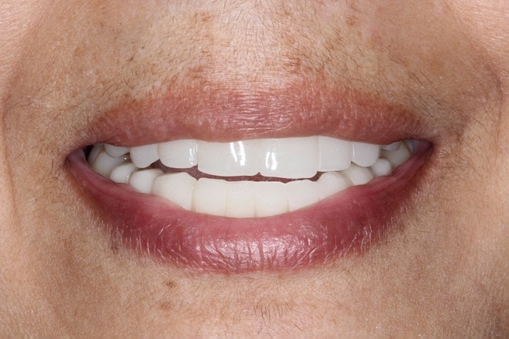 Cynthia Suarez (4) - Full Mouth Rehab - After