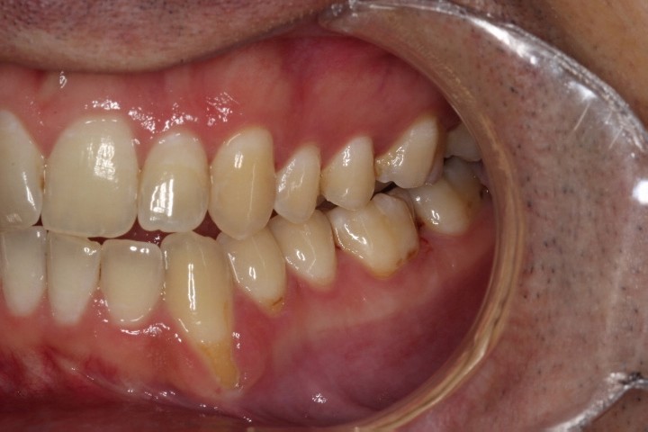 Derrek Johnson (1) - CTG LL - Before