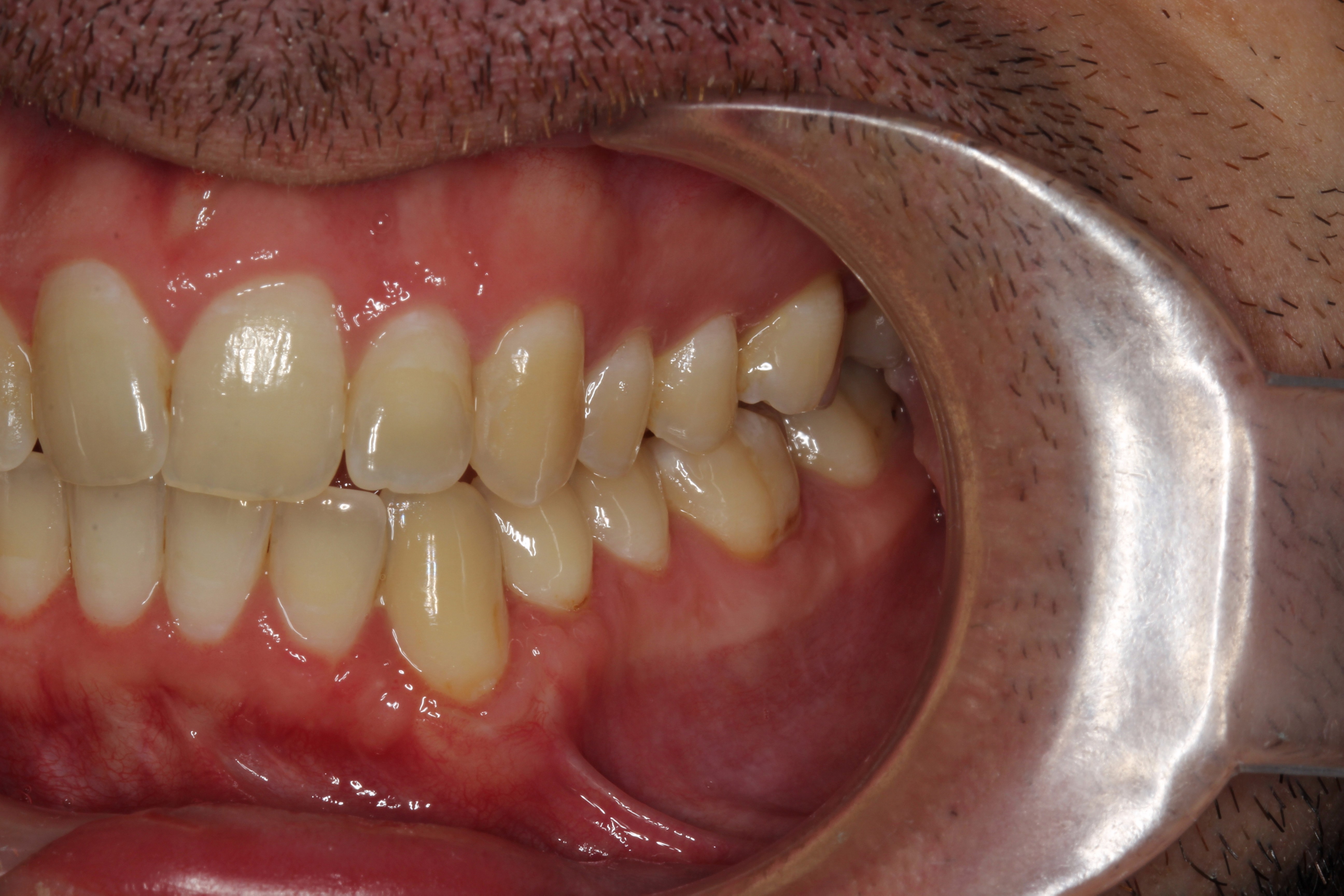 Derrek Johnson (2) - CTG LL - After