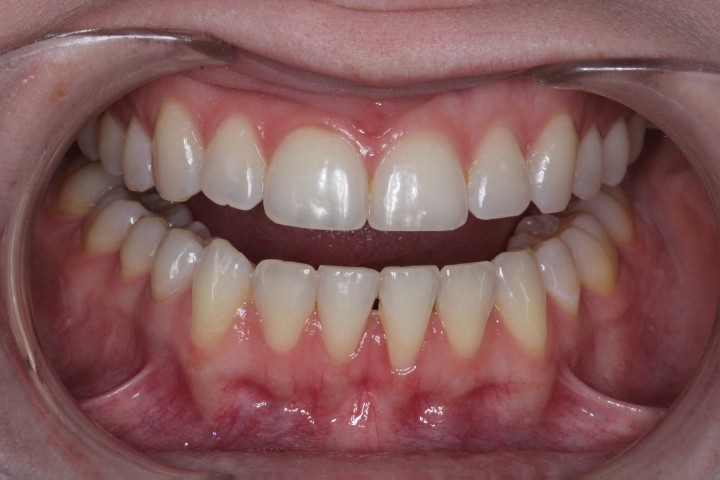 Elise Boyd (1) - CTG of LA - Before