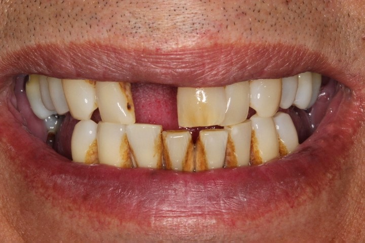 George Carrillo (3) - Full Mouth Rehab -Before (2)