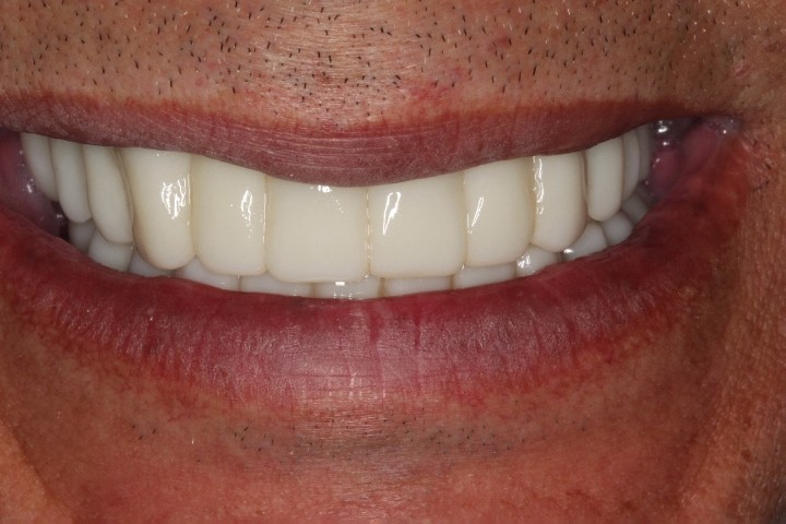 George Carrillo (4) - Full Mouth Rehab - After (2)