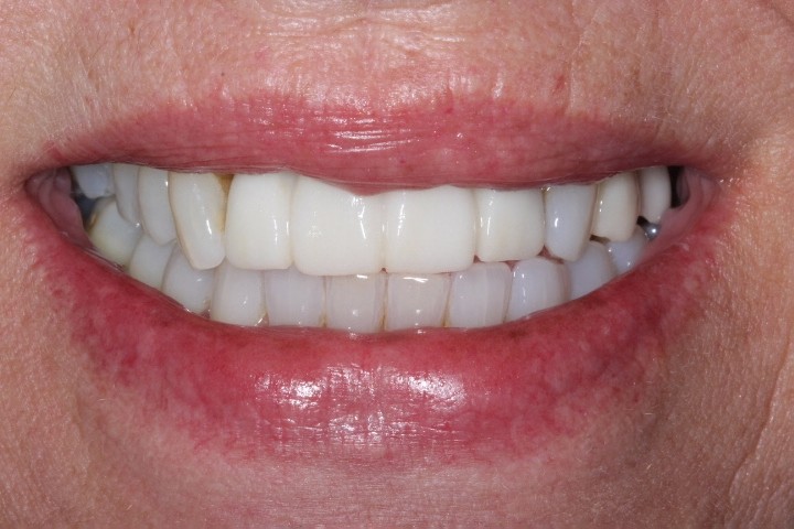 Lisa Corsentino (2) Anterior implants - After