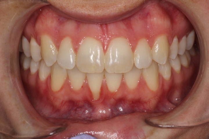 Madeleine E. Johnson (1) - CTG LA -Before